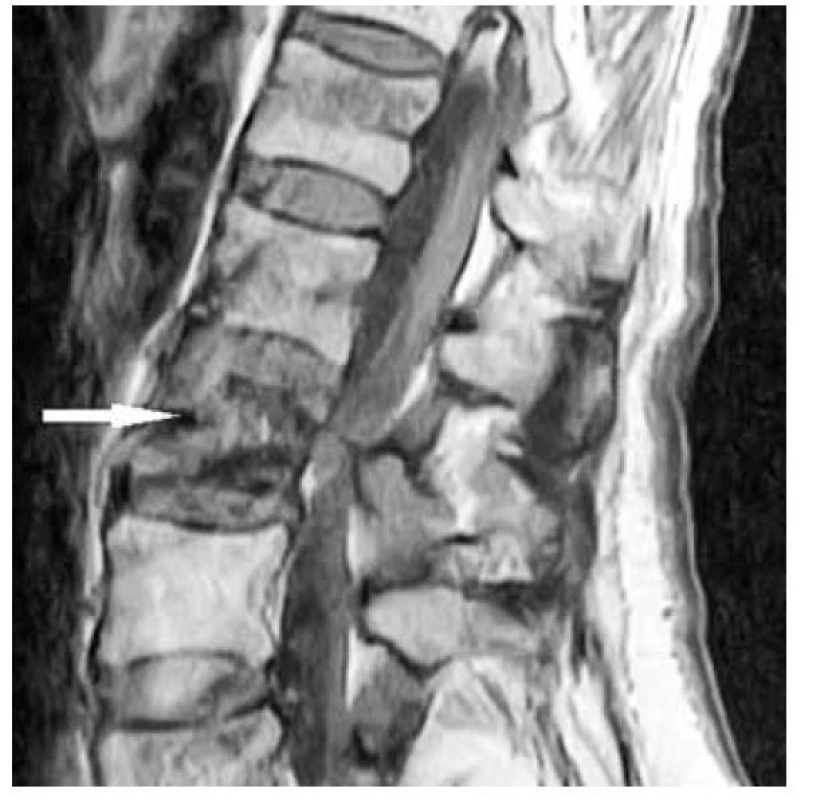 MRI LS oblasti – fosfaturický mezenchýmový tumor lokalizovaný
v L2 stavci