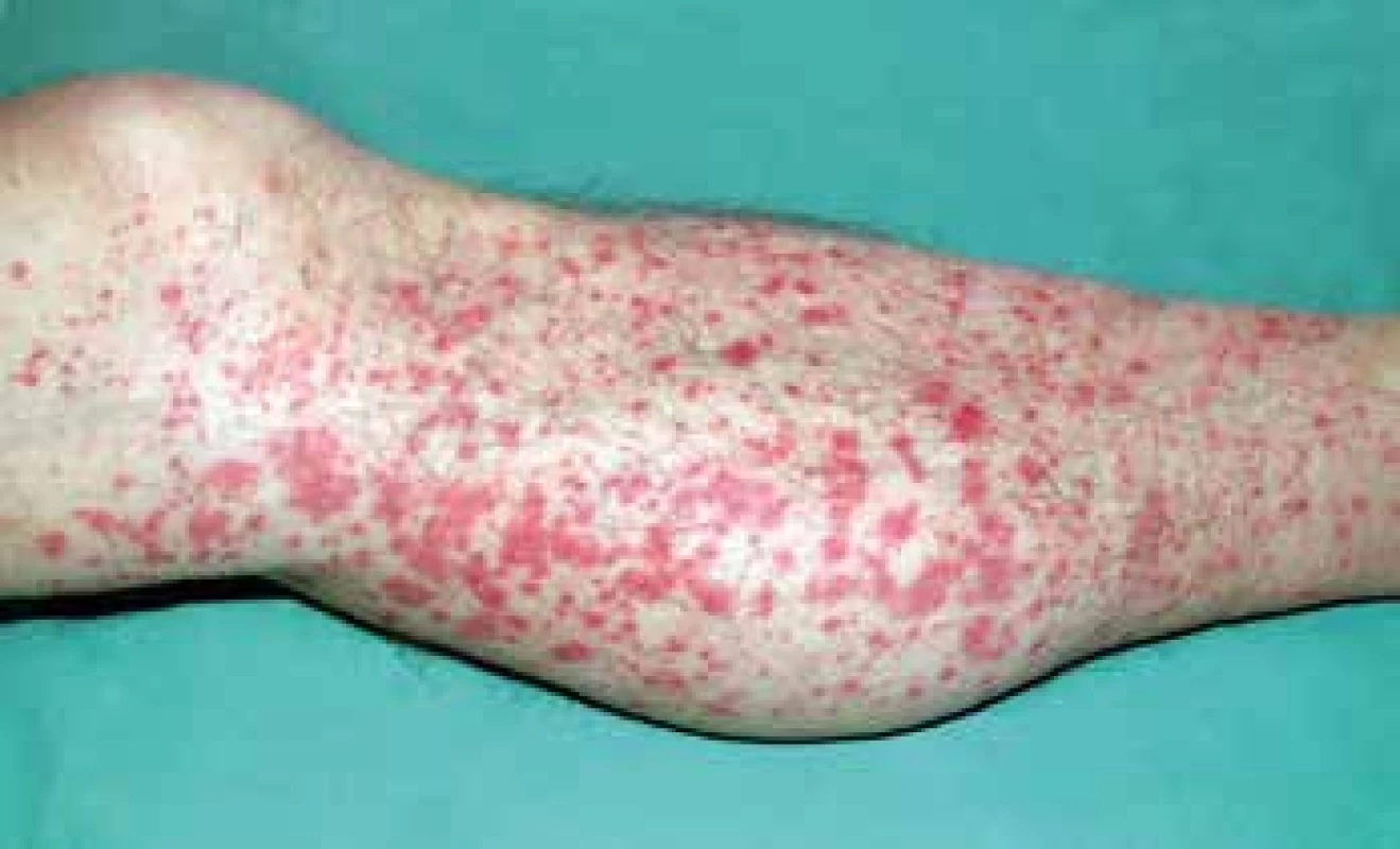 IgA vaskulitida – prominující purpura.