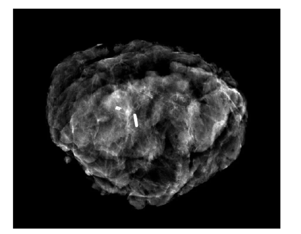 Radiografický snímek mamárního resekátu s klipem
a jodovým zrnem (PACS MOÚ Brno)<br>
Fig.2: Radiographic image of mammary specimen with
the clip and iodine seed (PACS MMCI Brno)