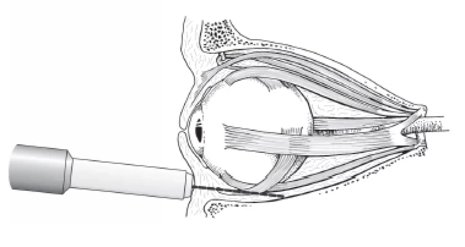Ultrasound examination of orbit: schematic representation
of paraocular method of examination of orbit