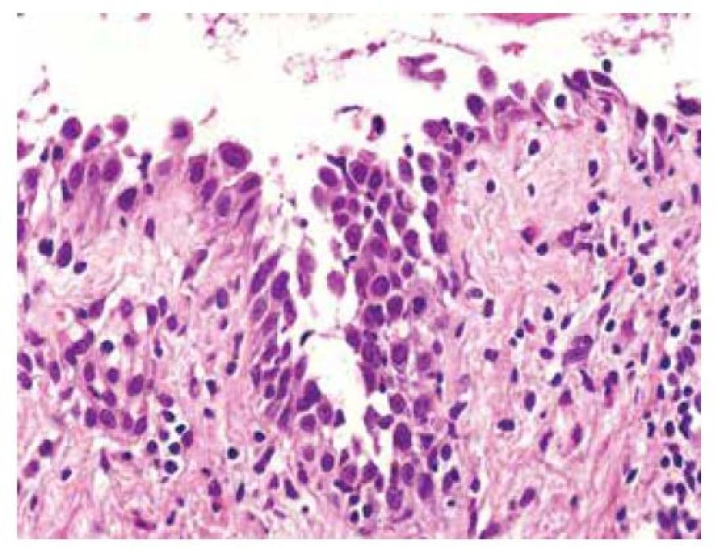 Pemphigus vulgaris
