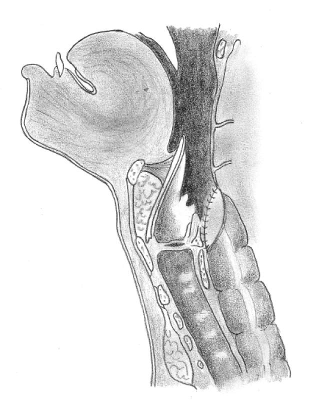 Kolofaryngoplastika (autor MUDr. Adam Kešner, převzato
z literatury) (8).