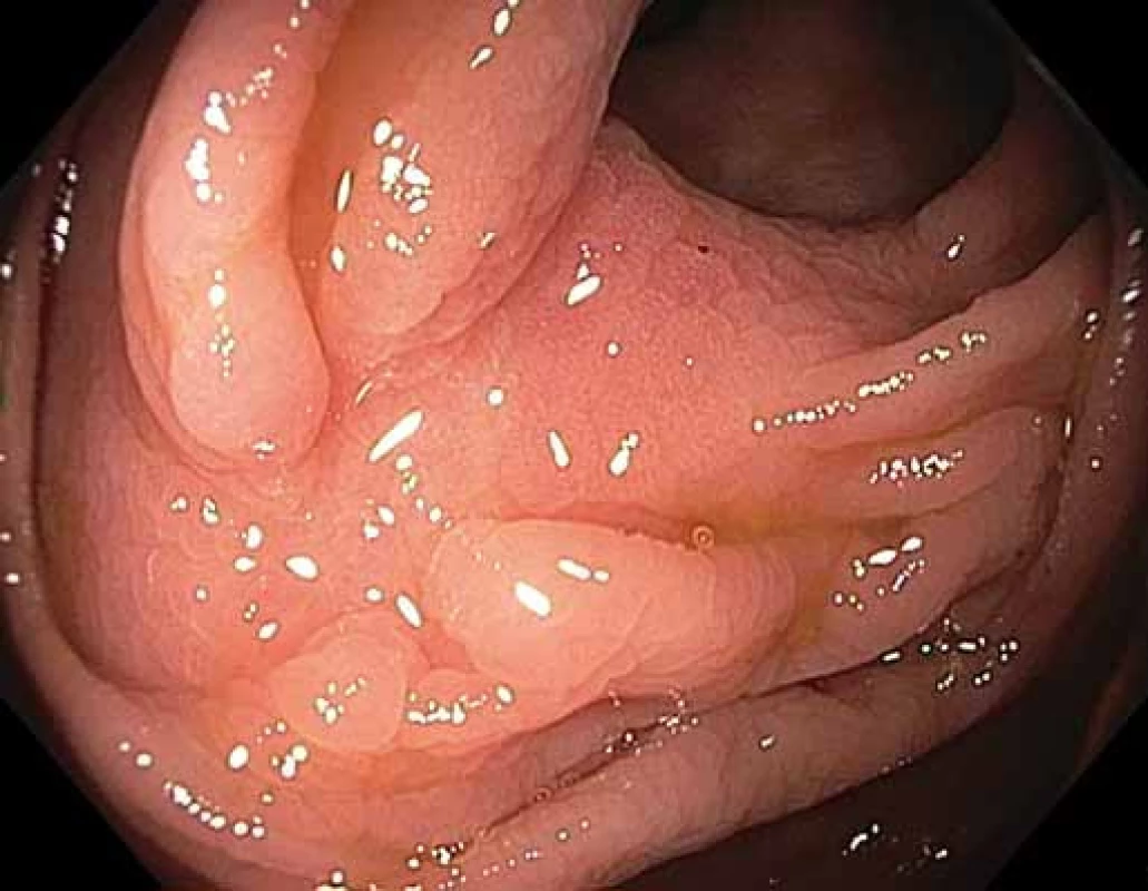 Klidná jizva po FTR LRN hepatální flexury.<br> Fig. 5. Negative scar after FTR of a LRN in the hepatic flexure.