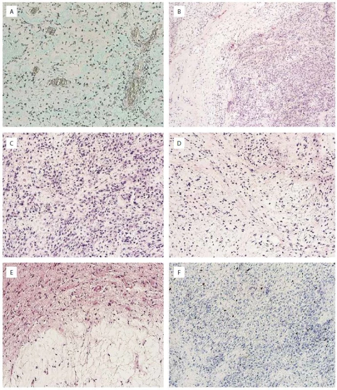 Histologický nález primárního tumoru.<br>
A. Průkaz kyselých mukopolysacharidů v tumoru. Alciánová modř, zvětšení 100×.<br>
B. Přehledný snímek tumoru. Hematoxylin-eozin, zvětšení 40×.<br>
C. Buněčnější partie tumoru. Hematoxylin-eozin, zvětšení 100×.<br>
D. Méně buněčná partie tumoru. Hematoxylin-eozin, zvětšení 100×.<br>
E. Okraj tumoru přecházející v nenádorovou mozkovou tkáň. Hematoxylin-eozin, zvětšení 100×.<br>
F. Proliferační aktivita měřená indexem Ki67. Imunohistochemické barvení, zvětšení 100×.