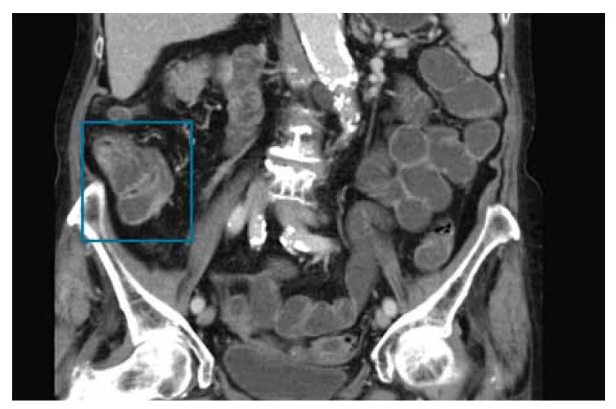 MR enterografie s nálezem zánětlivých změn ileocékální oblasti
(v modrém rámečku).<br>
Fig. 2. MR enterography with inflammatory changes of the ileocecal region
(blue box).
