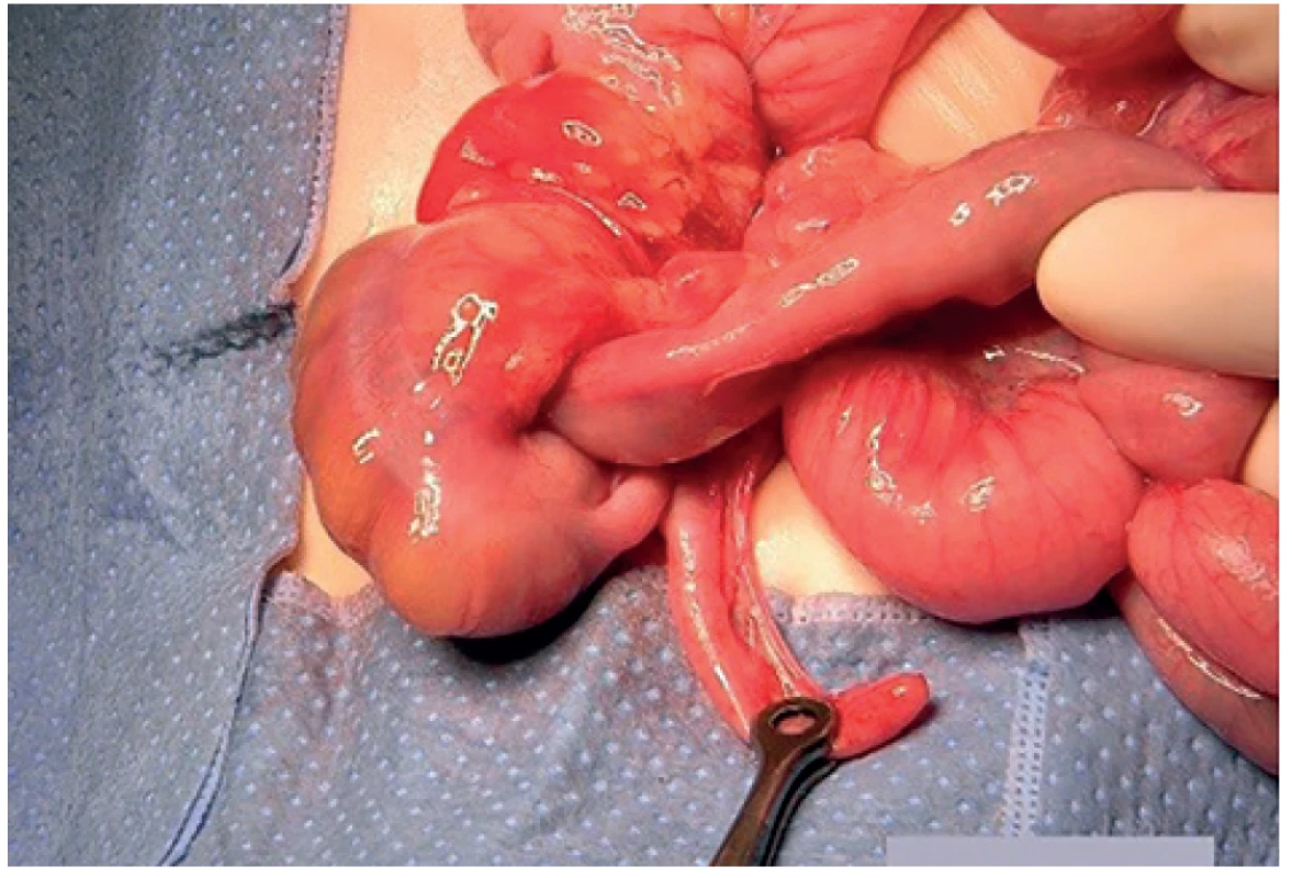 Ileokolická invaginace, peroperační nález <br>
Fig. 3: Intraoperative view of an ileocolic intussusception