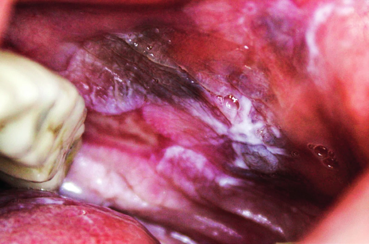 Pigmentace u orálního lichen planus