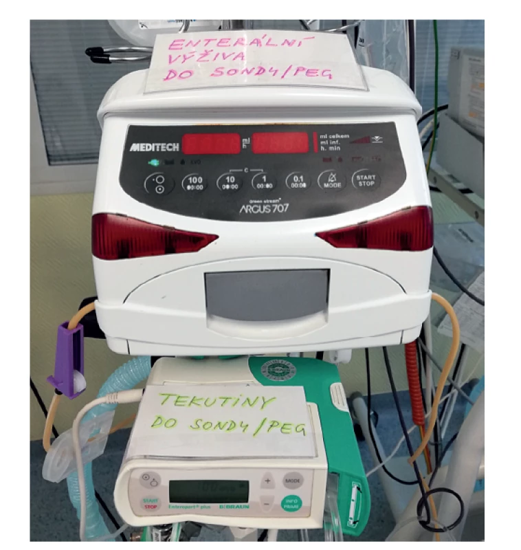 Praktické označení obou pump k enterální aplikaci<br>
Fig. 3: Practical description of both enteral feeding pumps