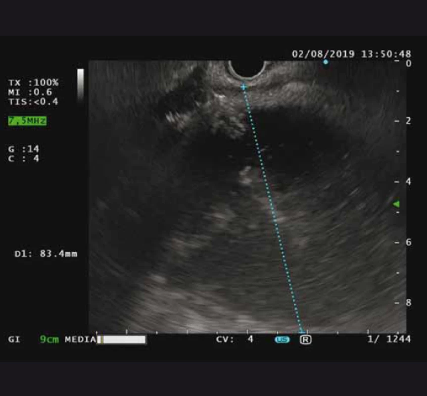 Lineární endosonografie – ohraničená retrogastrická
tekutinová kolekce s heteroechogenním obsahem.<br>
Fig. 2. Linear endosonography – walled-off retrogastric fluid
colection with heteroechogenic content.