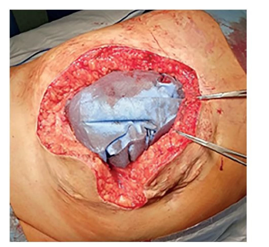 Excidovaný defekt břišní stěny<br>
Fig. 2: Excised defect of the abdominal wall