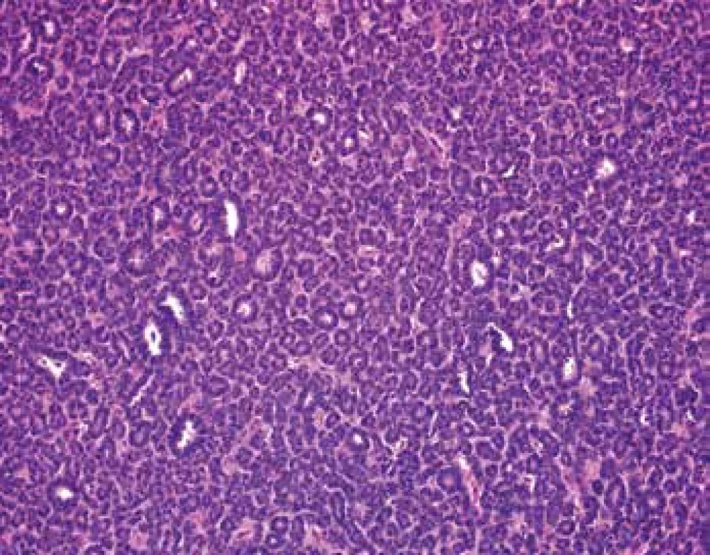 Tumor is composed predominantly of tightly packet tubules and acinar
structures with minimal stroma (HE, 200x).