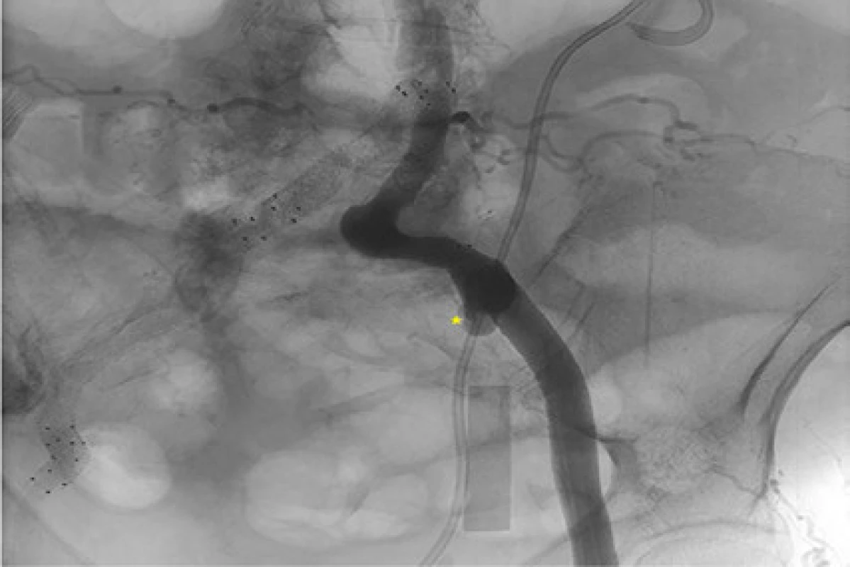 Pseudoaneuryzma<br>
Fig. 2. Pseudoaneurysm
