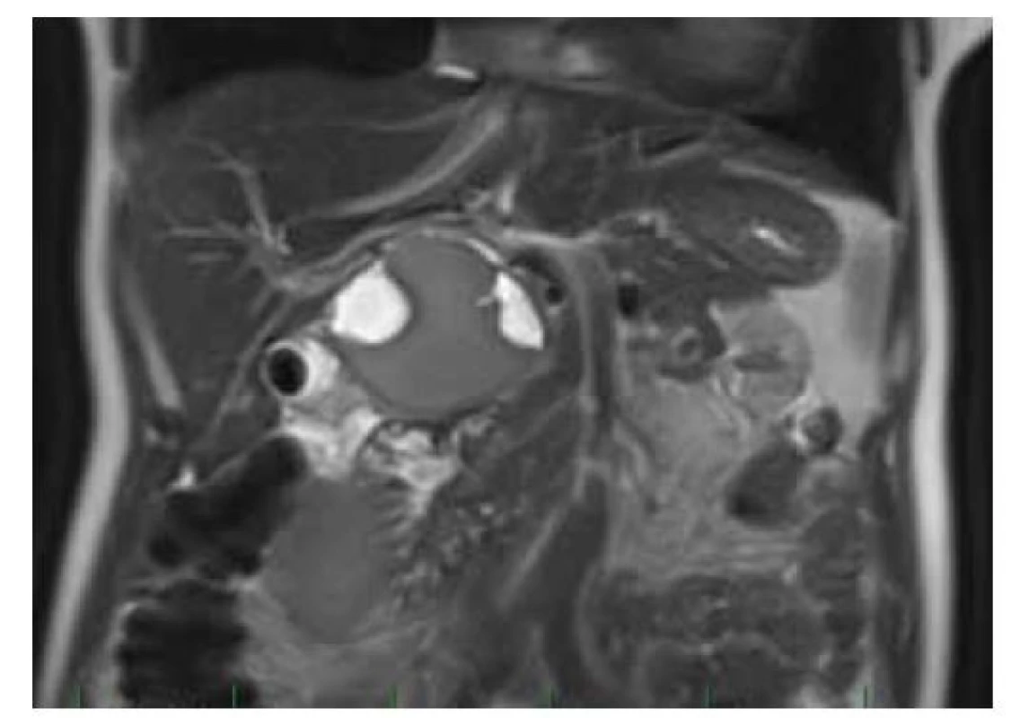 MR: cystické ložisko utlačující d. choledochus
s vícečetnými T2W hypersignálními porcemi.<br>
Fig. 4. MRI: cystic lesion oppressing the d. choledochus with
multiple T2W hypersignal portions.