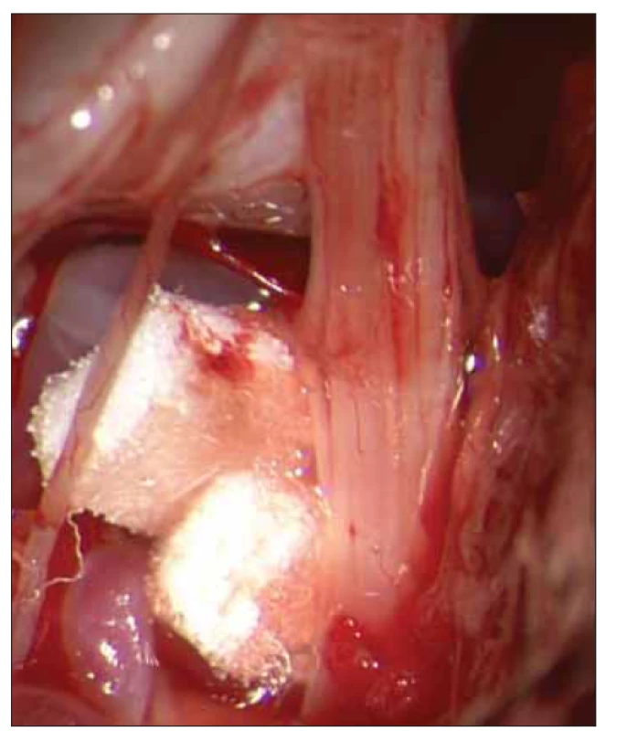 Mikrovaskulární dekomprese. Konflikt zrušen pomocí
dvou teflonových destiček.<br>
Fig. 2. Microvascular decompresion. Conflict has been eliminated
using two teflon patches.
