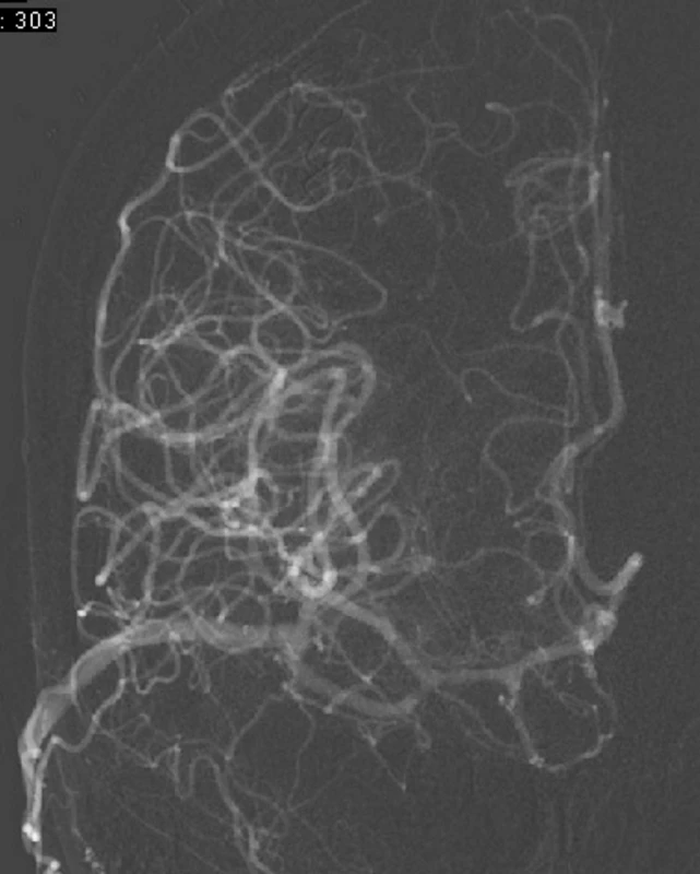 (a) High-flow bypass ECA-M2(t) na DSA. (b). Kapilární fáze průtoků bypassem.<br>
Fig. 3. (a) High-flow ECA-M2(t) bypass on DSA. (b) Bypass flow in capillary phase on DSA. 