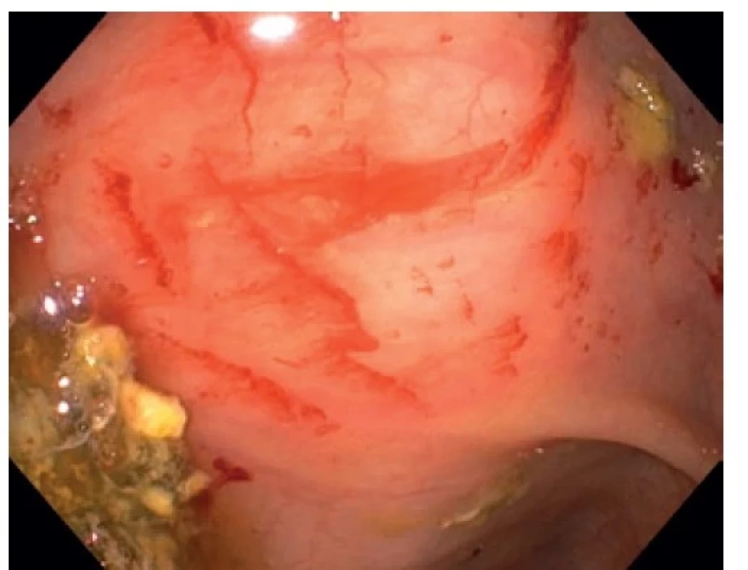 Endoskopický obraz – vícečetné sáknoucí angiektázie
v céku a proximálním colon ascendens<br>
Fig. 1: Endoscopic image – multiple leaking angioectasias
in the cecum and proximal ascending colon