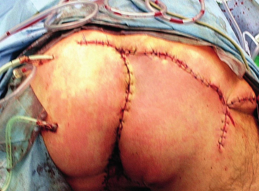 Pooperační nález<br>
Fig. 7: Postoperative finding