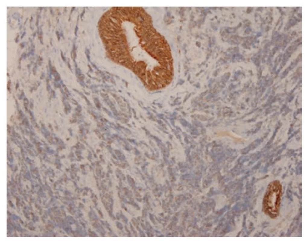 Granulární cytoplazmatická pozitivita malobuněčného karcinomu
v imunohistochemickém průkazu cytokeratinu AE1/AE3, kontrastující se silnou
cytoplazmatickou pozitivitou výstelky žlázky. 100x.