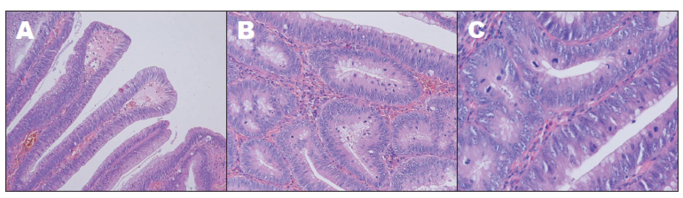 Histologické nálezy, barvení hematoxylin-eosinem: A – zvětšení 100x, B – zvětšení 200x, C – zvětšení 400x.