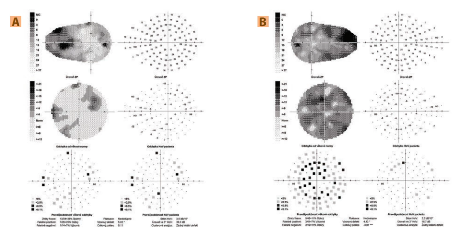  (A) Glaucoma perimeter of right eye: non-specific relative to absolute scotomas in visual field, high loss of fixation (B) Glaucoma perimeter of left eye: diffuse decrease of sensitivity of visual field
