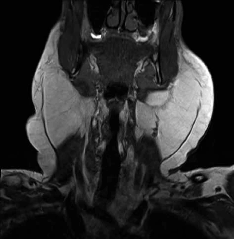 MRI krku s laterálně uloženými lipomy<br>
Fig. 4: MRI of neck with laterally deposited lipomas