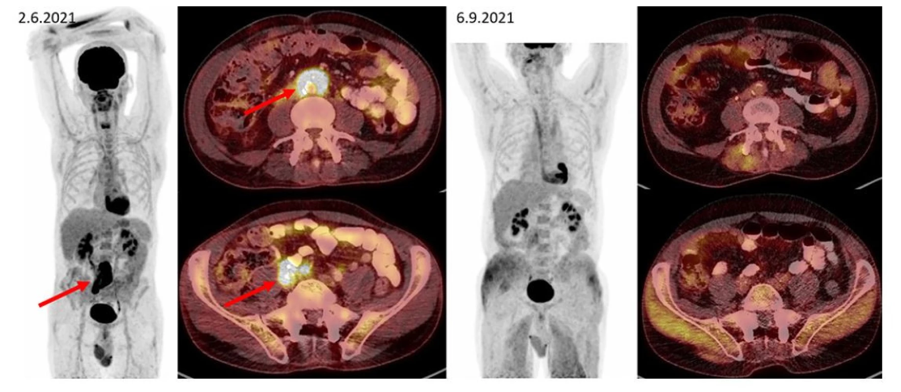 F–FD6 PET/CT vyšetření u pacienta s ložiskem retroperitoneální fibrózy s histologicky potvrzenou diagnózou IgG4-RD. Šipkami jsou označeny
kraniální i kaudální porce metabolicky aktivní infiltrace v retroperitoneu obkružující kaudální část břišní aorty, oblast bifurkace a dále odstup pravostranných
společných ilických cév (v infiltrátu je zavzat pravostranný ureter s JJ stentem). Pacient byl léčen rituximabem, dexametazonem a cyklofosfamidem.
Po této léčbě tato metabolicky aktivní infiltrace při kontrolním vyšetření zaniká. Další akumulace radiofarmaka v rámci variant fyziologického zobrazení