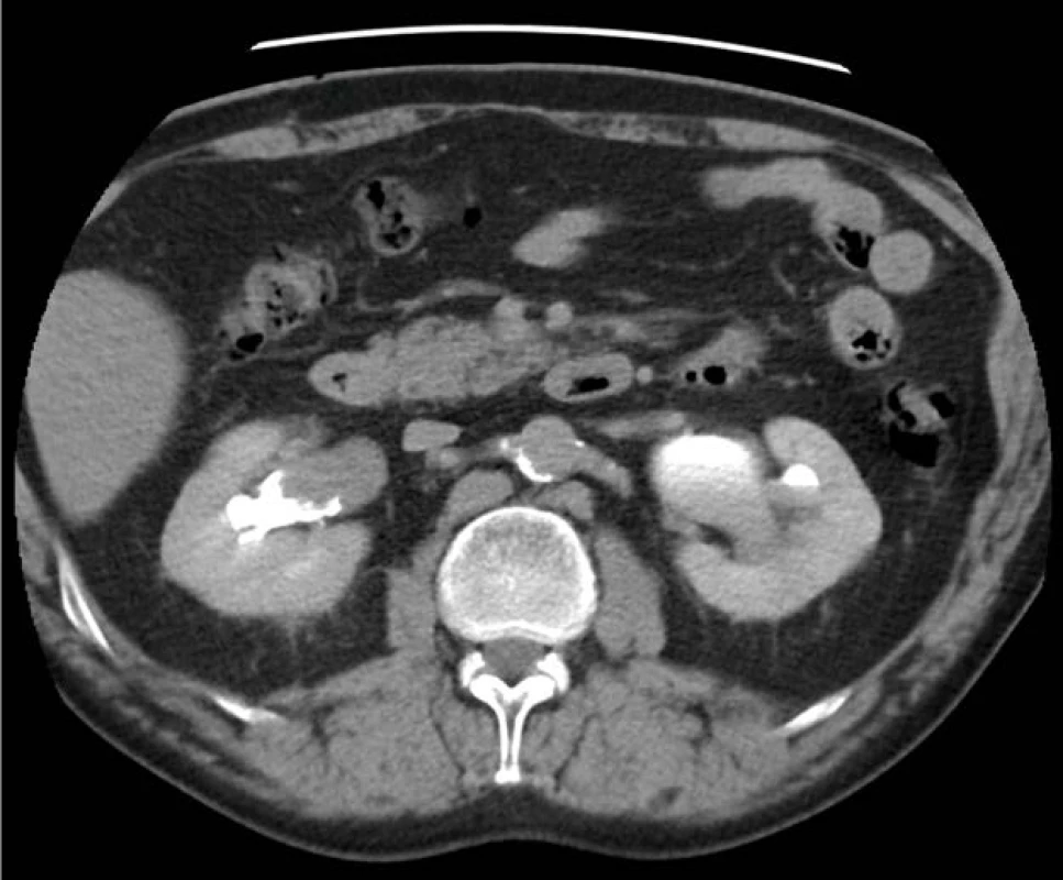 CT-IVU – tumor ledvinné
pánvičky vpravo na transverzálním
řezu (zdroj: Krajská zdravotní, a. s.)<br>
Fig. 1. CT-IVU – tumor of right
renal pelvis (transverse plane)