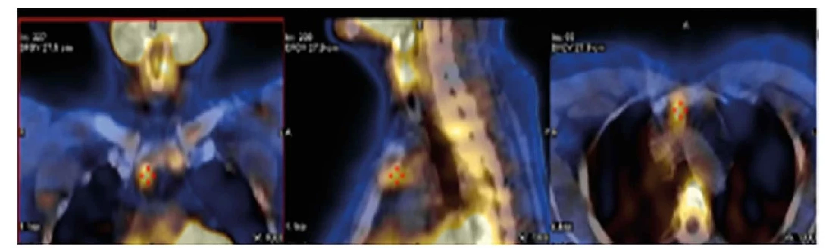 MIBI, adenom příštítného tělíska ve tkáni thymu<br>
Fig. 1: MIBI, parathyroid adenoma in thymic tissue