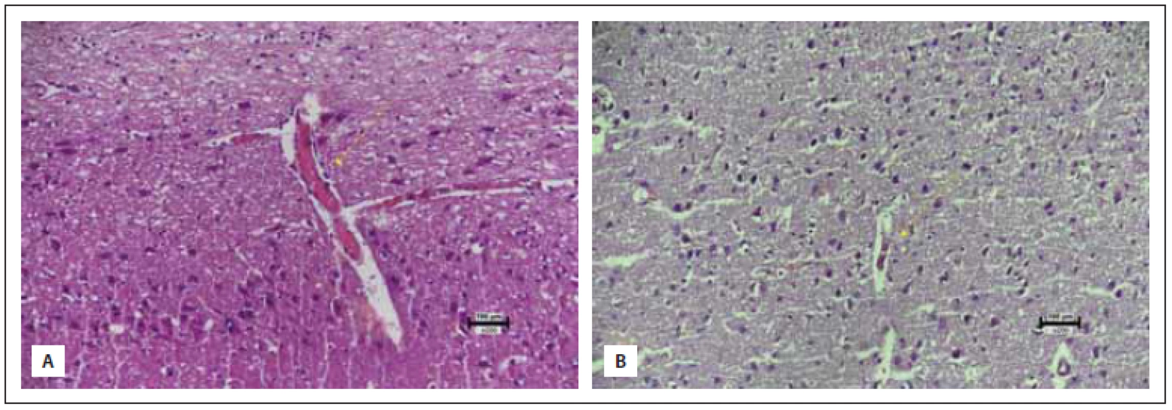 (A) Two congested vascular structures at 1 hpf in the trauma group (score 1). (B) One congested vascular structure per 1 hpf in
the sumatriptan group (score 2) (hematoxylin eosin 200×) <br> 
Obr. 4 (A) Dvě utlačené vaskulární struktury na 1 hpf ve skupině s traumatem (skóre 1). (B) Jedna utlačená struktura na 1 hpf ve skupině
na sumatriptanu (skóre 2) (hematoxylin-eozin 200×).