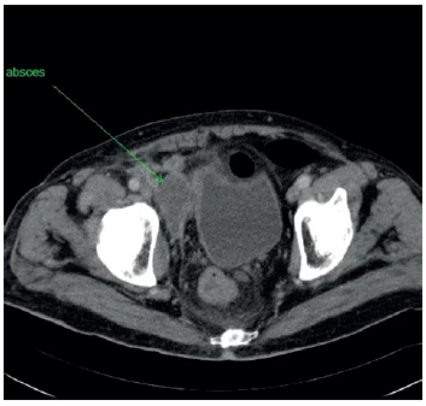 Rozšírenie abscesu do malej panvy <br> 
Fig. 4. Extension of the abscess into the small pelvis
