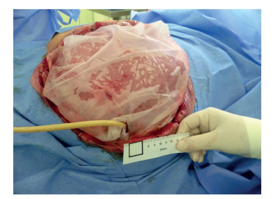 Katétr v píštěli<br>
Fig. 2: Catheter in the fistula