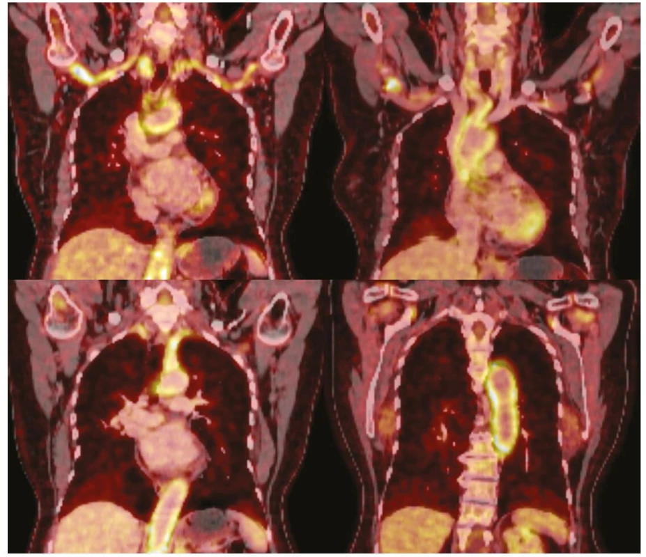 Typický nález LV-GCA na PET/CT