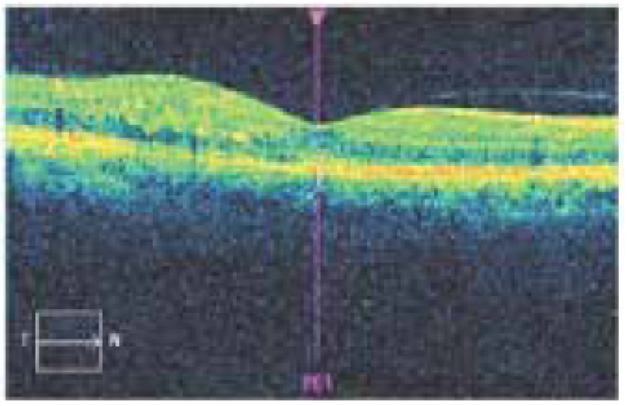 Image of optical coherence tomography in the
same patient obtained after 3 intravitreal injections of
ranibizumab, central retinal thickness 292 μm, residual
edema in the upper part of the central landscape, best
corrected visual acuity 6/7.5. Further injections were
not indicated, the residual edema was spontaneously
absorbed without the necessity of further reapplication,
throughout the period of the following year the patient
maintained visual acuity of 6/6