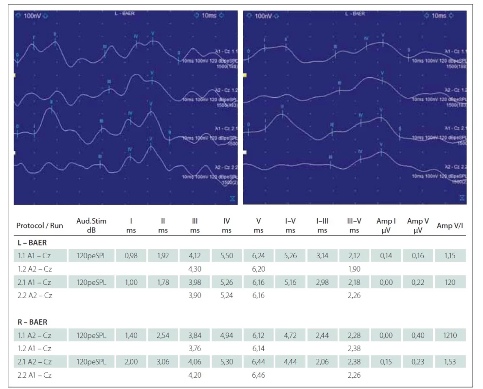 Sluchové kmenové evokované potenciály. Latence jsou v mezích normy, stranově symetrické, nižší amplitudy.<br>
Fig. 2. Brainstem auditory evoked potentials. Wave latencies have normal values, side symmetric, lower amplitudes.