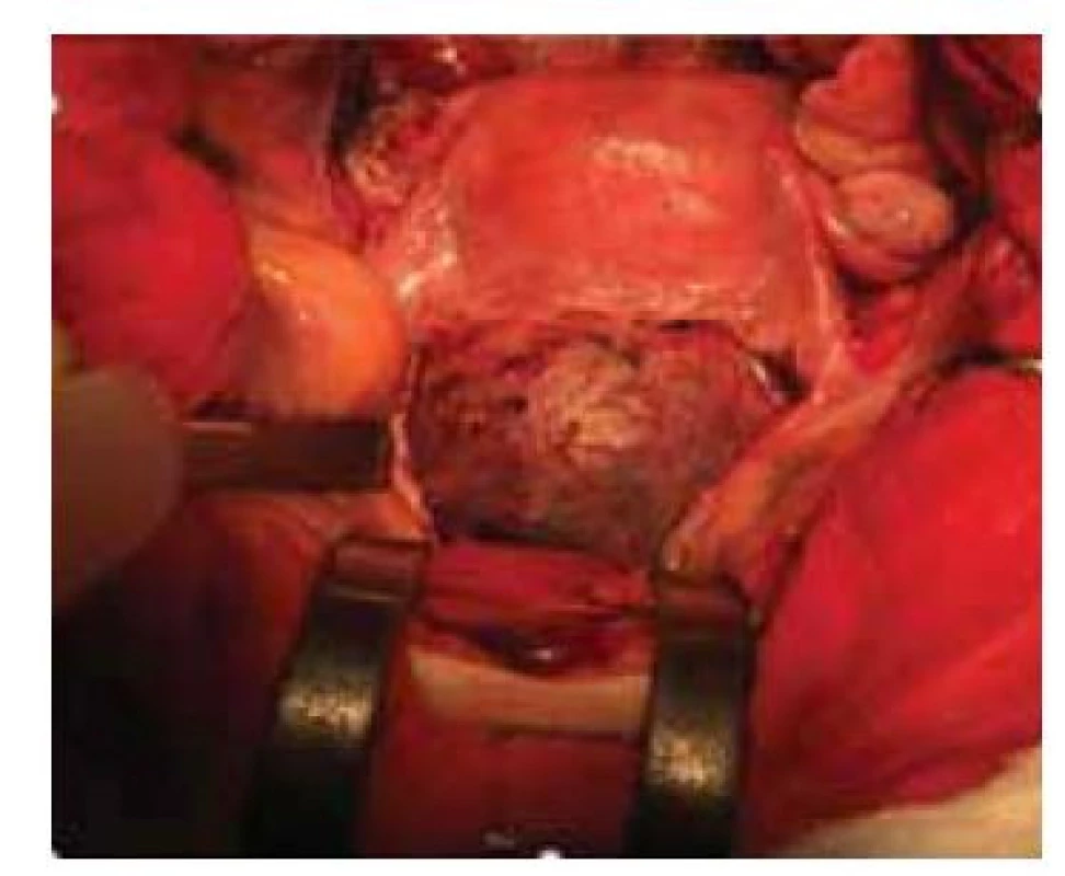 Laparotomický pohled na graviditu
v jizvě po císařském řezu. Gestační
stáří – 11. týden.<br>
Fig. 4. Laparoscopic view of pregnancy
through a scar after caesarean section.
Gestational age – 11th week.