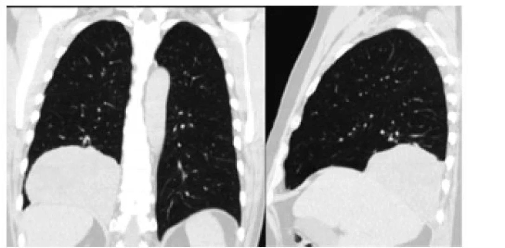 Solitárny fibrózny tumor dolného laloka pravých
pľúc v bazálnej časti pleurálnej dutiny (CT pracovisko
NÚTPCHaHCH Vyšné Hágy, Vysoké Tatry)<br>
Fig. 3: Solitary fibrous tumor of the lower lobe of the right
lung in the basal part of the pleural cavity (CT department
NUTPCHaHCH Vysne Hagy, Vysoke Tatry)