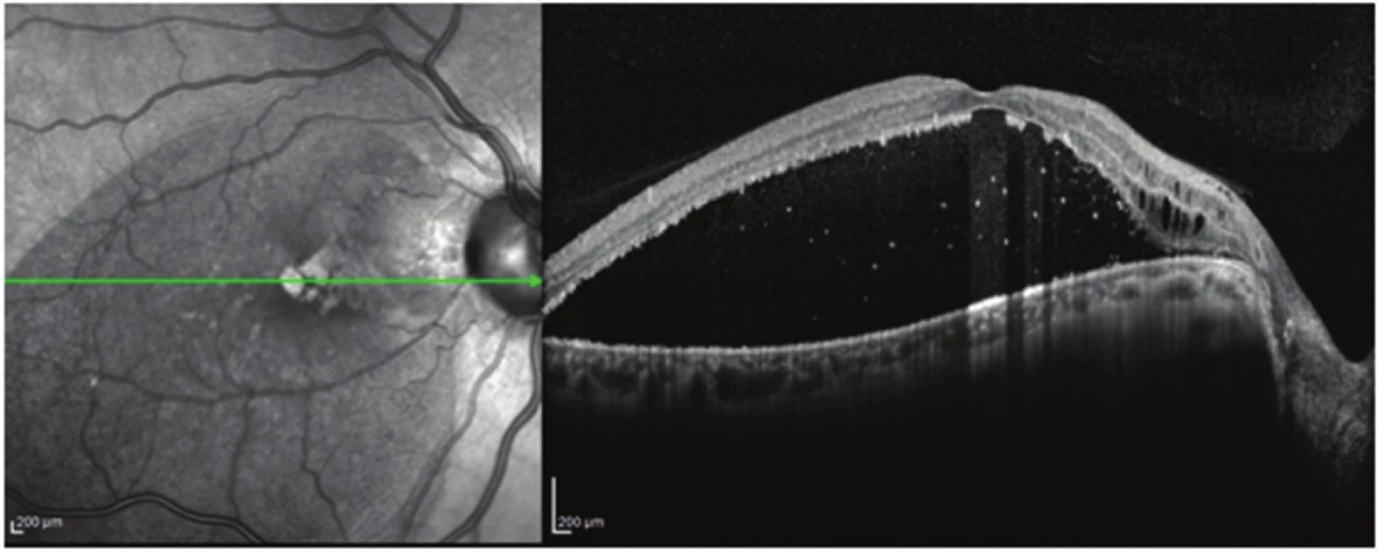 Patient no. 6 Linear horizontal transfoveolar OCT scan of RE before PPV, macular retinoschisis of internal and external retinal layers with subretinal fluid