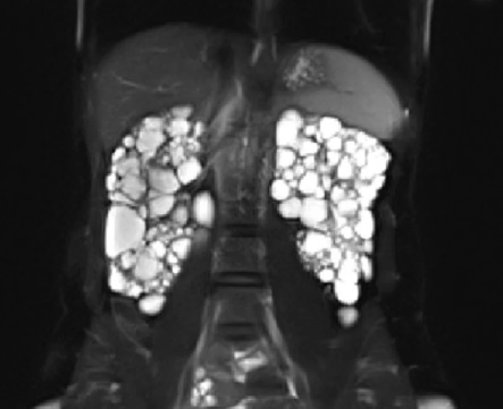 MRI, koronární řez. Polycystické ledviny u nemocné s tuberózní sklerózou<br>
Fig. 9. MRI scan, coronal plane. Polycystic kidneys of
the patient with tuberous sclerosis