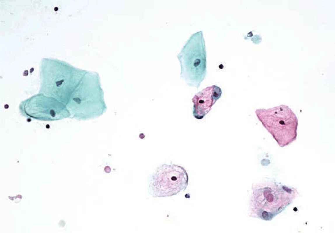 Dermoidní cysta. Zralé dlaždicové epitelie. Polychrom. 400x