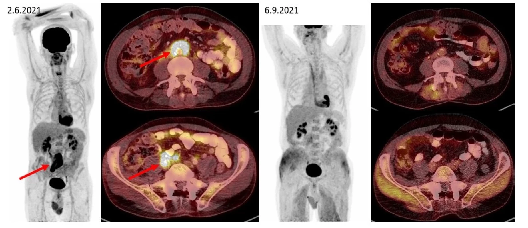 Pacient s ložiskem retroperitoneální fibrózy s histologicky potvrzenou diagnózou IgG4-RD. Šipkami jsou označeny kraniální i kaudální porce
metabolicky aktivní infiltrace v retroperitoneu obkružující kaudální část břišní aorty, oblast bifurkace a dále odstup pravostranných společných ilických
cév (v infiltrátu je zavzat pravostranný ureter s JJ stentem). Pacient byl léčen rituximabem, dexametazonem a cyklofosfamidem. Po léčbě tato metabolicky
aktivní infiltrace při kontrolním vyšetření zaniká. Další akumulace radiofarmaka v rámci variant fyziologického zobrazení