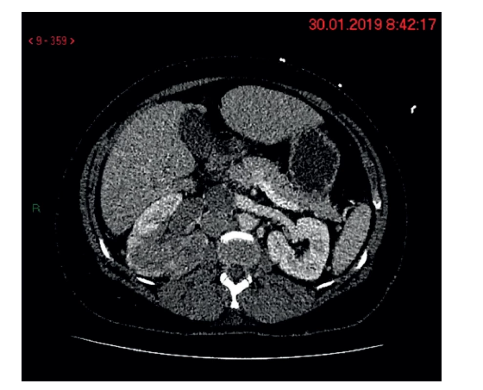 Pravá oblička s nádorom a v. renalis s nádorovým
trombom a zväčšenými retrokaválnymi uzlinami<br>
Fig. 1: Right kidney with the tumor and v. renalis with tumor
thrombus and enlarged retrocaval lymph nodes