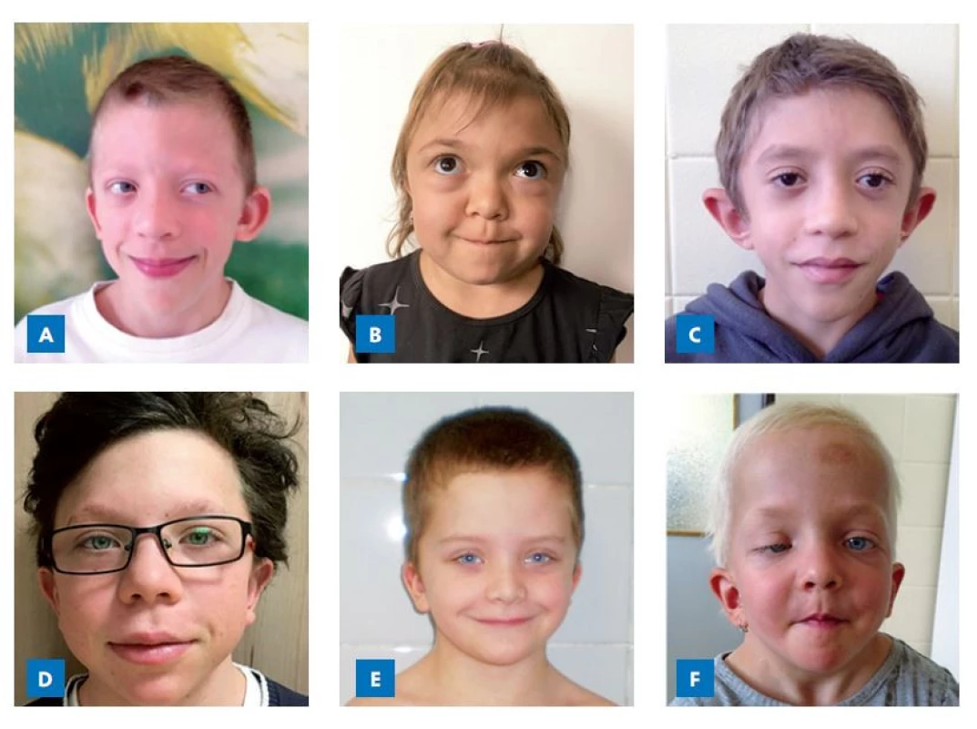 Faciální fenotypy dětí se
syndromem Noonanové na podkladě
patogenních variant jednotlivých
genů Ras/MAPK signalizační
kaskády. A – SOS1; B – KRAS;
C – SOS1; D – PTPN11; E – PTPN11;
F – SHOC2