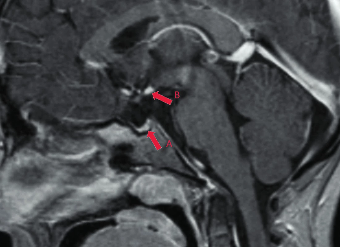 Magnetická rezonance mozku. PSIS („pituitary stalk interruption syndrome“) s nálezem hypoplastické hypofýzy (A), ektopicky uložené neurohypofýzy (B) a chyběním stopky hypofýzy. (Vlastní fotodokumentace)<br>
Fig. 2. Magnetic resonance imaging of the brain. PSIS („pituitary stalk interruption syndrome„) with pituitary hypoplasia (A), ectopic posterior pituitary (B) and absence
of pituitary stalk.