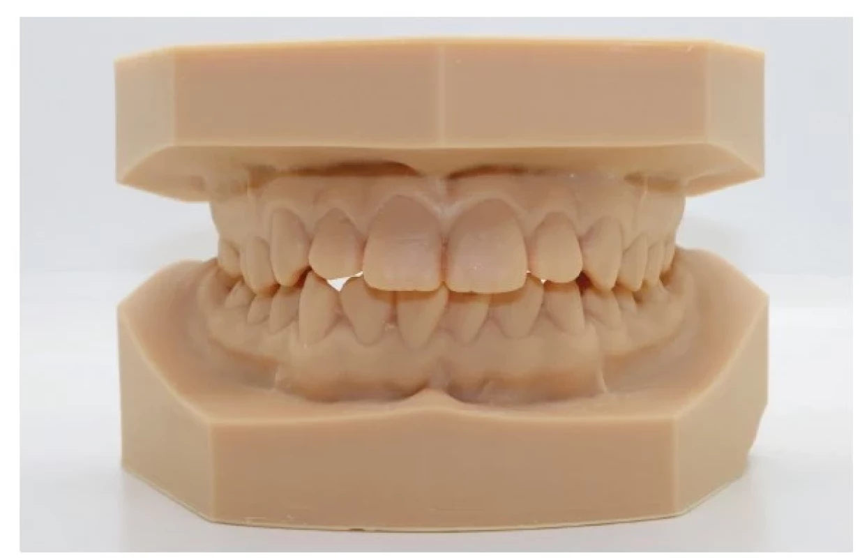 3D tištěné modely chrupu.<br>
Fig. 2
3D printed dental models.