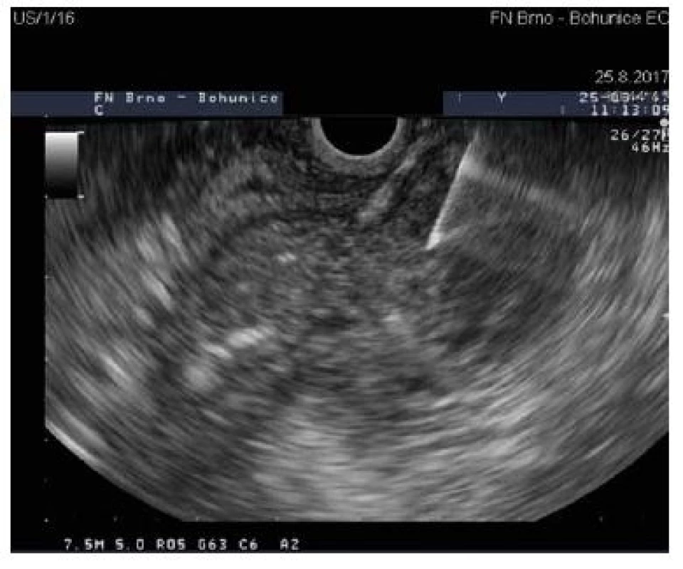 Linear EUS image of FNAB – the aspiration needle is clearly visible as an echogenic line.<br> Obr. 3. FNAB ze solidního ložiska hlavy pankreatu – aspirační jehla v ložisku je dobře patrna jako echogenní pruh.