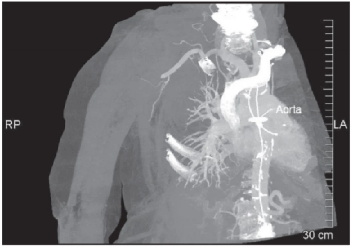 SCT angiography procedure finds closure of right axillary and
brachial artery