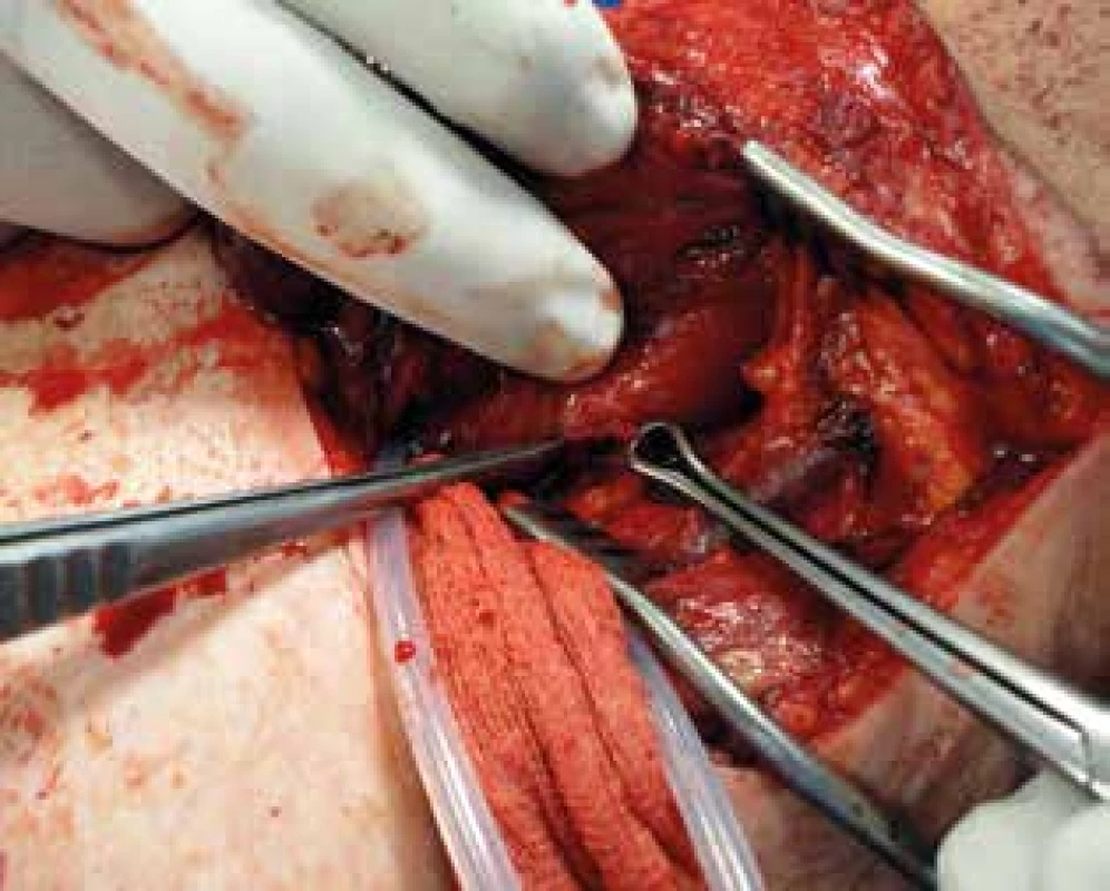 Perforace jícnu v Zenkerově divertiklu – intraoperační pohled z levostranné laterální krční incize s intraoperační endoskopií <br>Fig. 2: Oesophageal perforation in Zenker‘s diverticulum – intraoperative view from the left lateral cervical incision with intraoperative endoscopy