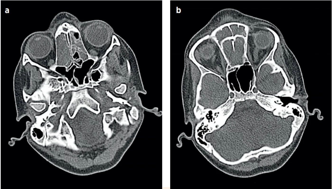 a, b (P1). Vstupní CT (1. hospitalizační den), obliterované ethmoidální dutiny, frontální dutiny a edém podkoží kořene nosu.
(Za laskavého přispění MUDr. Pavla Rejtara)<br>
Fig. 2a, b (P1). The CT imaging (the first day of the hospitalisation), obliteration of the ethmoid and frontal cavities, and hypodermal oedema of the nose root. (Credit Dr.Pavel Rejtar)