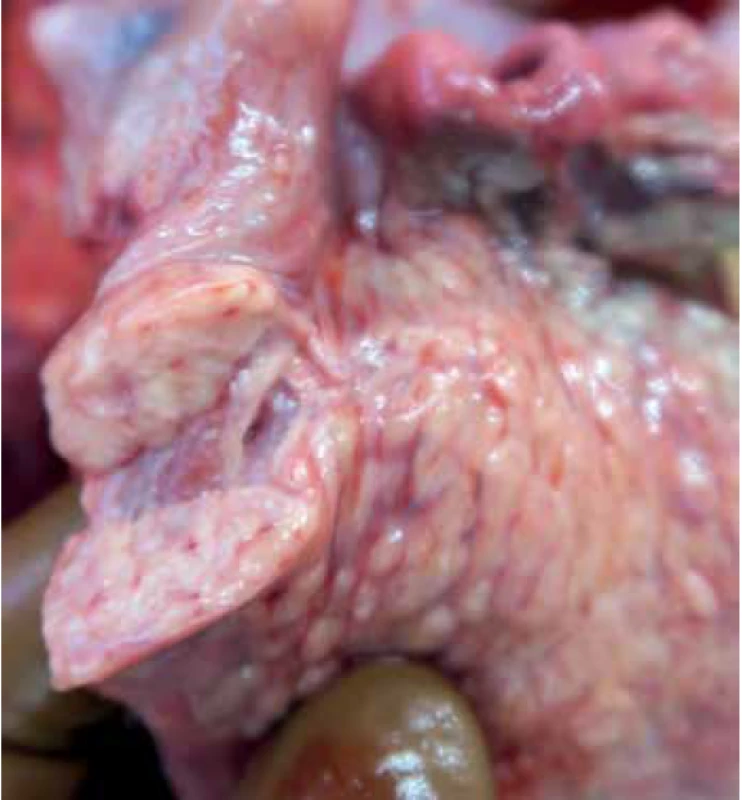 The right palatine tonsil without macroscopic changes.