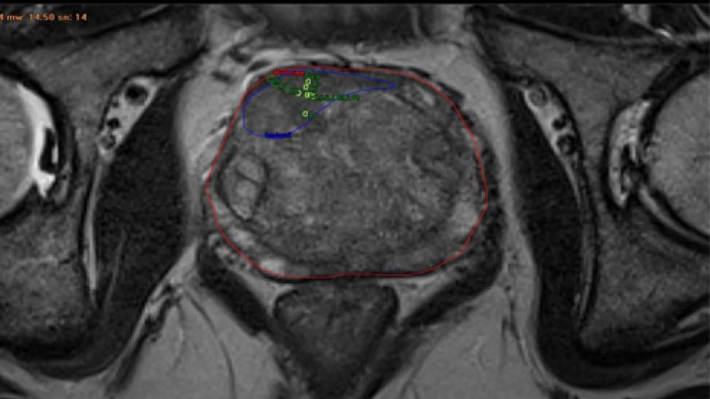 T2 vážená sekvence mpMRI transverzální řez; červeně – prostata; modře – suspektní ložisko KP; zelenožlutě
– bioptické vzorky<br>
Fig. 1. T2 weighted sequence mpMRI axial view; red – prostate; blue – suspect lesion of prostate cancer; greenyellow
– bioptic patterns